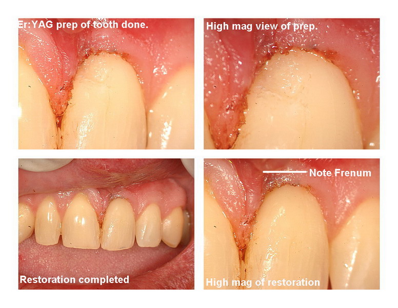 Frenectomy Pg 3 edited_resize.jpg